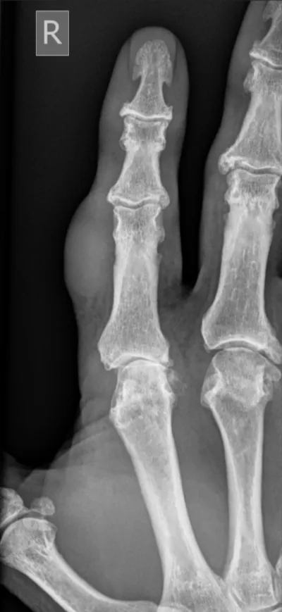 Giant cell tumour of tendon sheath