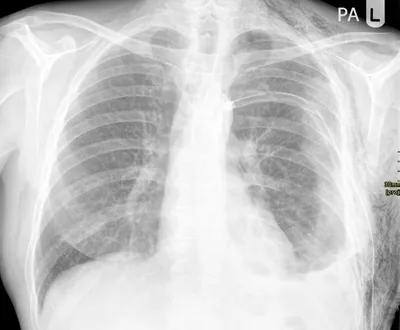 Left - Surgical emphysema + rib fractures