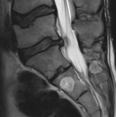 Vertebral haemangioma