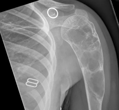 Aneurysmal Bone Cyst (ABC)