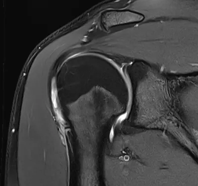 SLAP tear superior glenoid labrum