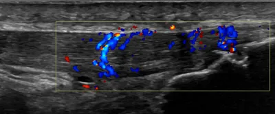 Patellar tendinopathy