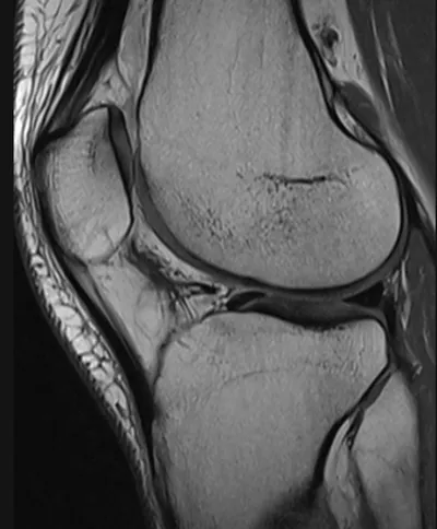 Hoffa fat pad scarring post arthroscopy