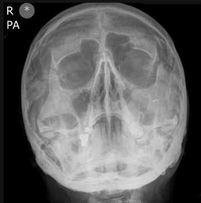 Zygomaticomaxillary complex (ZMC) fracture