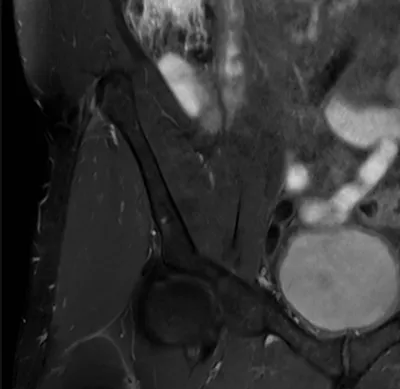High / Proximal iliotibial band syndrome