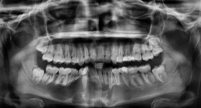 Ameloblastoma