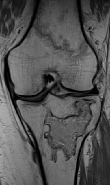 Multifocal bone infarcts