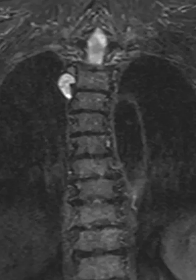 Peripheral nerve sheath tumour