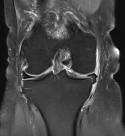 Bucket handle tear of medial meniscus