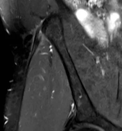 Proximal iliotibial band syndrome