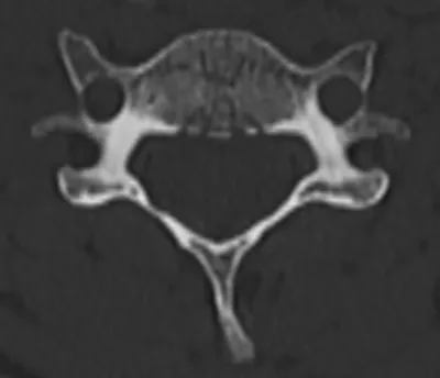 Basivertebral venous plexus anatomy