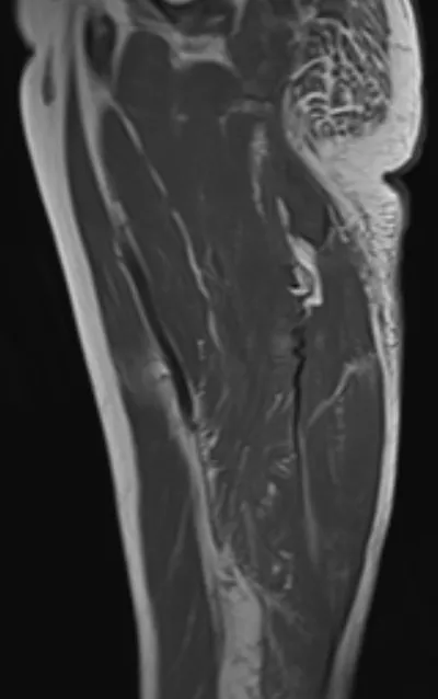 Corrugated tendon sign - torn retracted hamstring