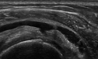 Supraspinatus bursal surface partial tear seen on bursography