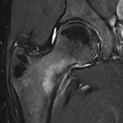 Femoral neck stress fracture