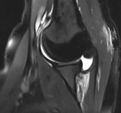 Normal ABER view shoulder arthrogram