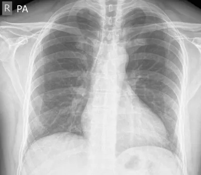 Left apical pneumothorax