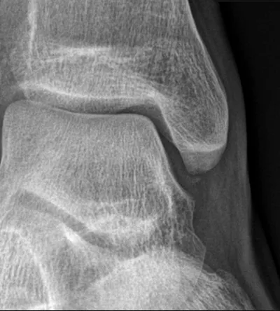 Subtle deltoid ligament avulsion injury