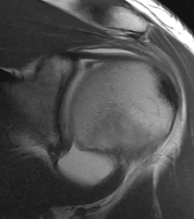 SLAP tear (Superior Labrum Anterior and Posterior)