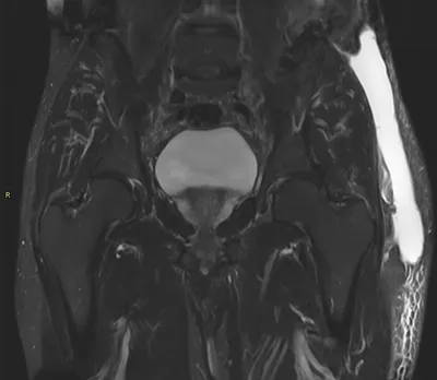 Morel Lavallée Lesion