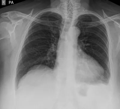 Pleural effusion and Pericardial effusion
