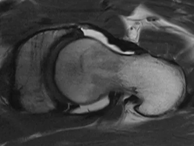 Posterior acetabular labral tear