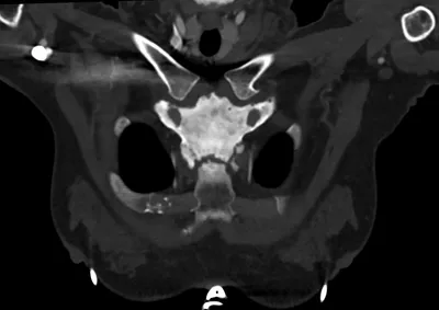 The Bull's head sign - SAPHO syndrome