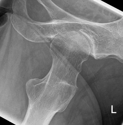 Osteoarthritis of hip seen on Dunne view