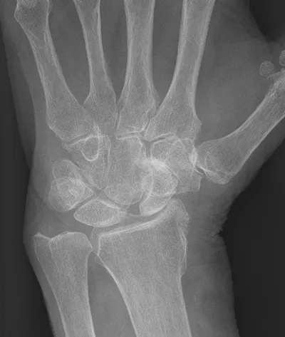 Scapholunate widening