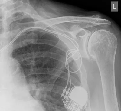 Glenohumeral osteoarthritis