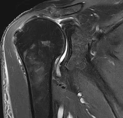 Rotator cuff tear - supraspinatus