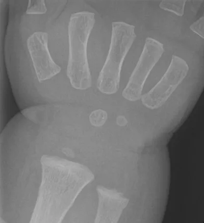 Distal radius fracture