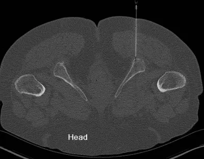 Common Hamstring Tendon Origin injection