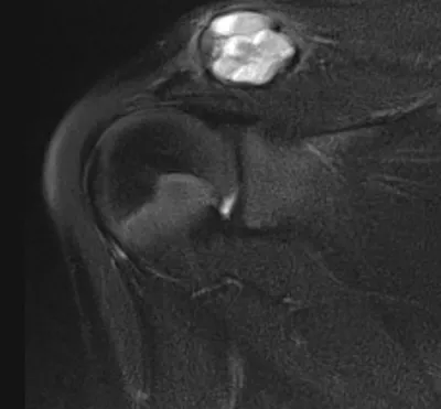 Aneurysmal Bone Cyst (ABC)
