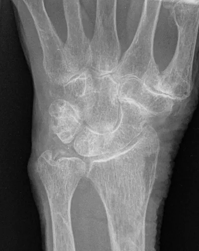 Scapholunate coalition