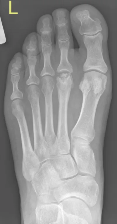 Freiburg osteonecrosis (AVN) of 2nd metatarsal head