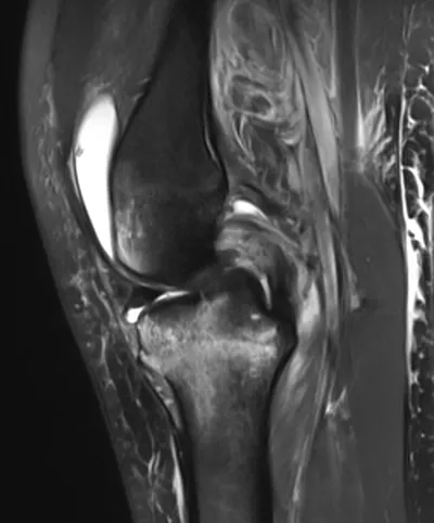 PCL injury from hyperextension