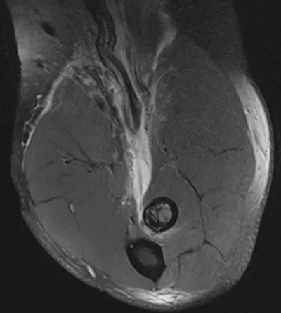 Torn distal biceps tendon (FABS View)