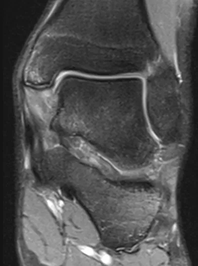 Deep deltoid ligament sprain injury
