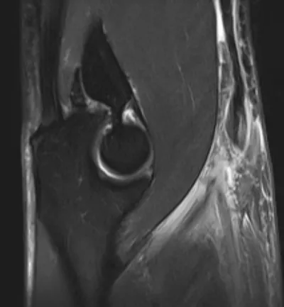 Lacertus fibrosus injury (biceps)