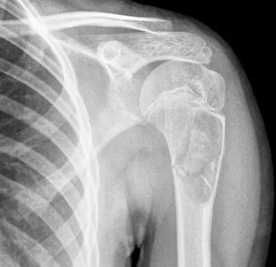 Unicameral cyst fallen fragment sign