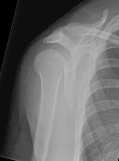 Posterior glenohumeral dislocation (Lightbulb sign)