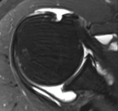 ALPSA lesion anteroinferior glenoid labral tear