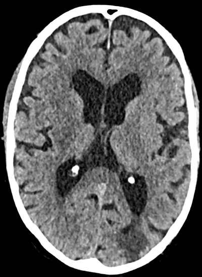 Left parietal lobe infarction