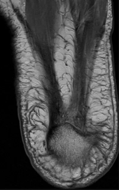 Plantar Fascia Anatomy