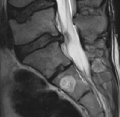 Vertebral haemangioma