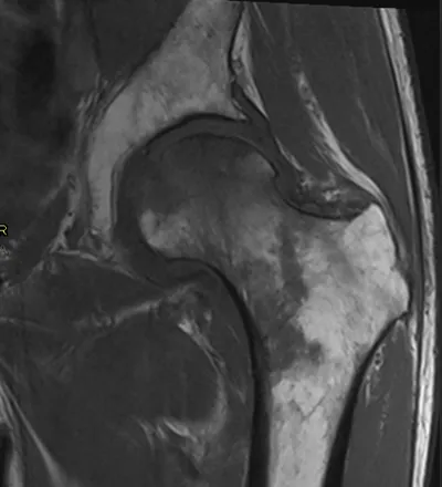 Avascular necrosis of femoral head