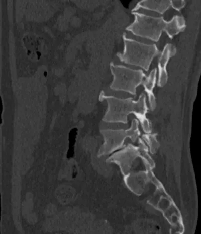 Spondylolisthesis + pars interarticularis fracture