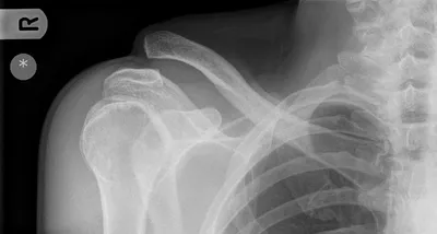 AC joint separation (Grade 5)