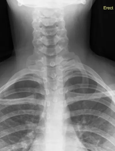 Left cervical rib