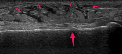Metatarsal stress fracture